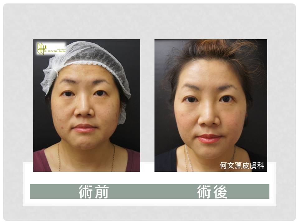 林口自體脂肪補臉