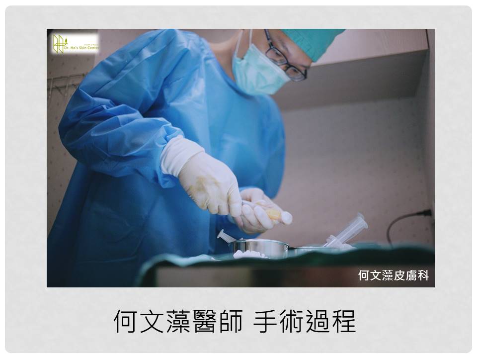 自體脂肪補臉
