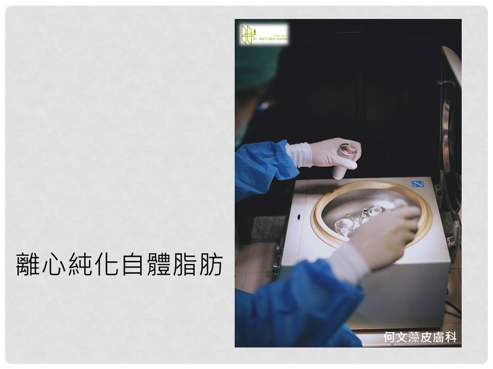 自體脂肪補臉