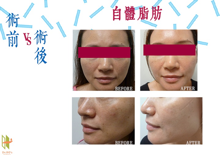 自體脂肪精雕臉部案例分享