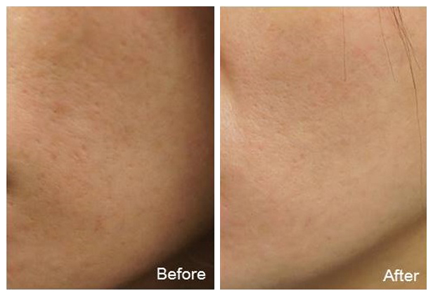 林口龟山医美sublative rf除皱